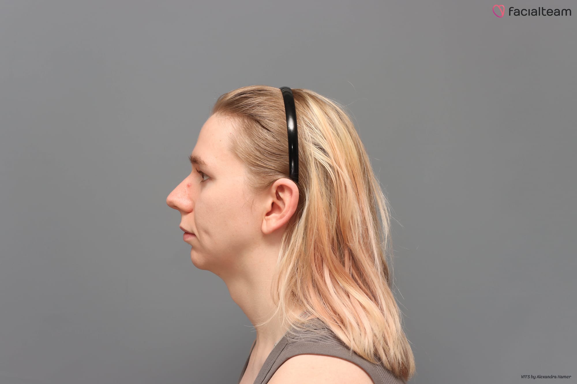 Profile photo of my face before FFS