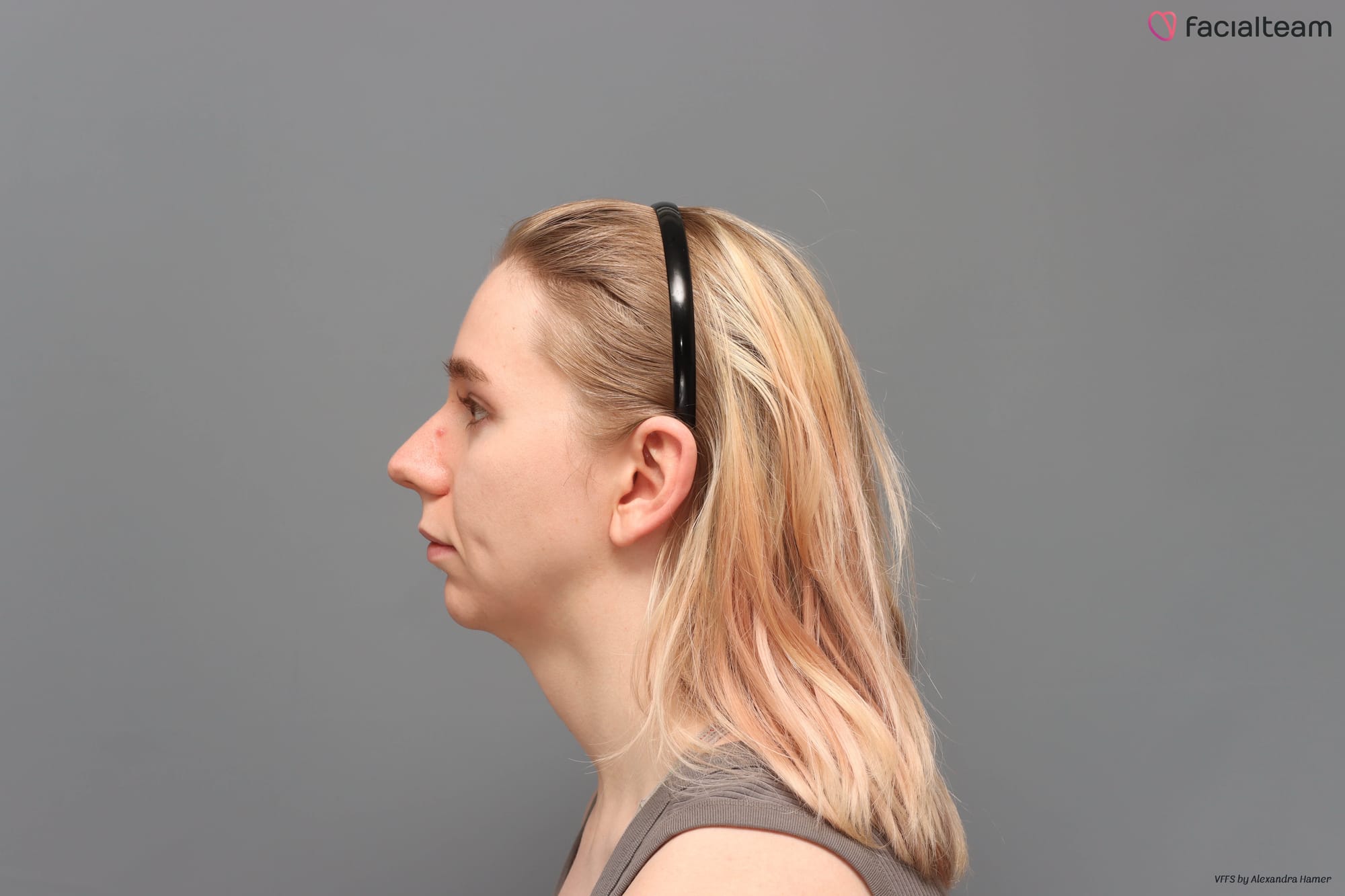 Profile visualisation of FFS, showing a reduced forehead profile, reduced trachea, and hair coverage on the temples.