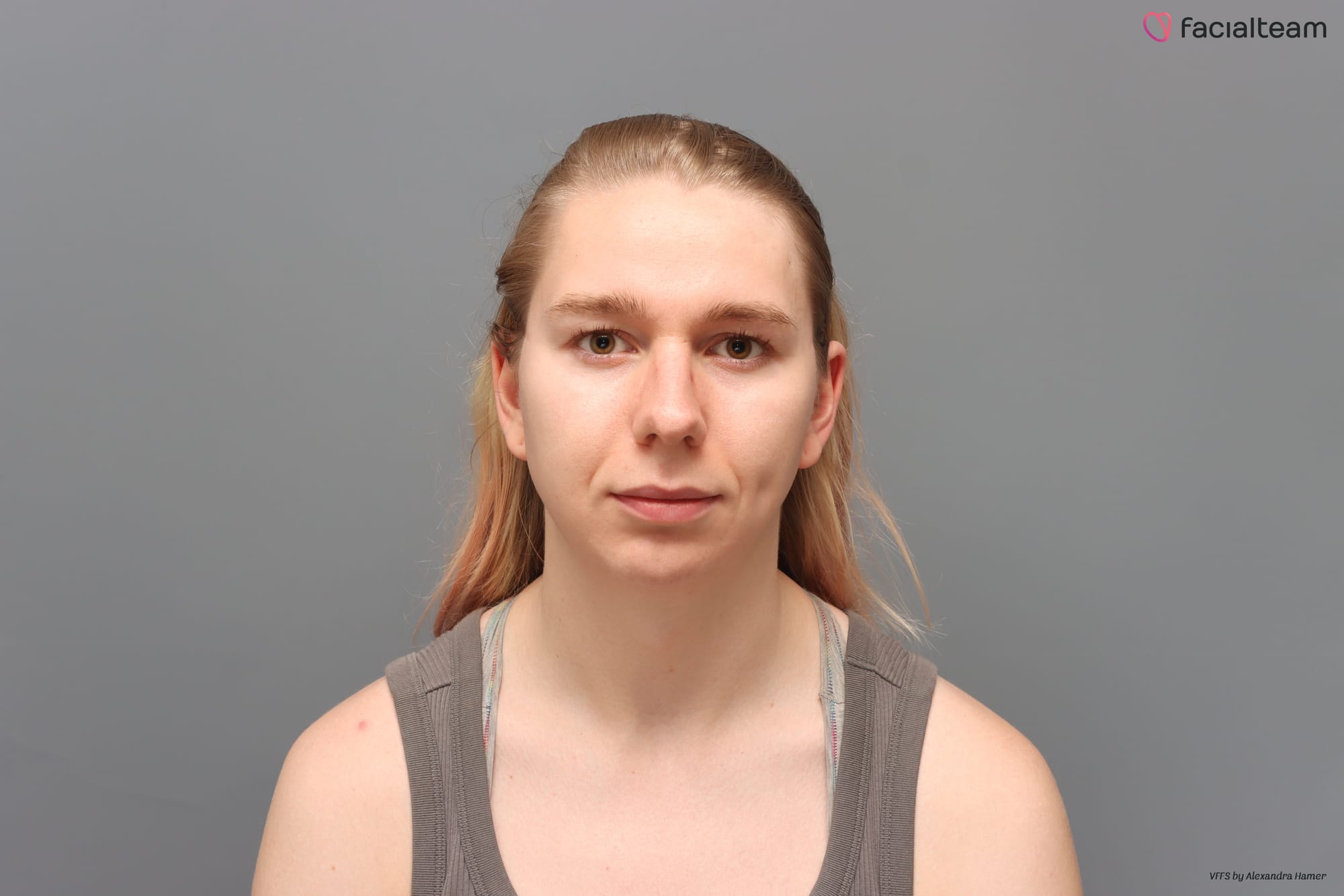 Portrait photo of my face before FFS.