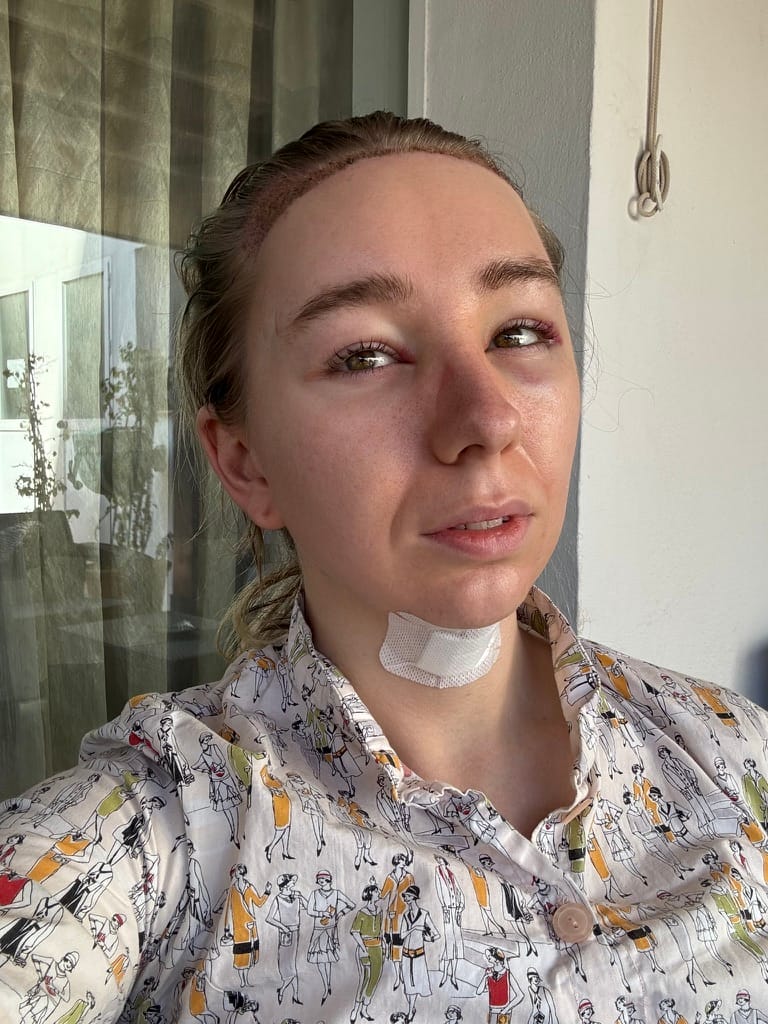 Maisie sitting outside post-op. She has a bandage on her neck and her hair is clipped back to ensure that the hair transplants heal unimpeded. She is looking bruised and swollen.