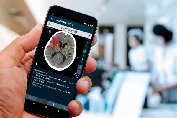 Greek-founded Brainomix raised over €18M to scale its AI solution and support physicians treat cancer and lung fibrosis