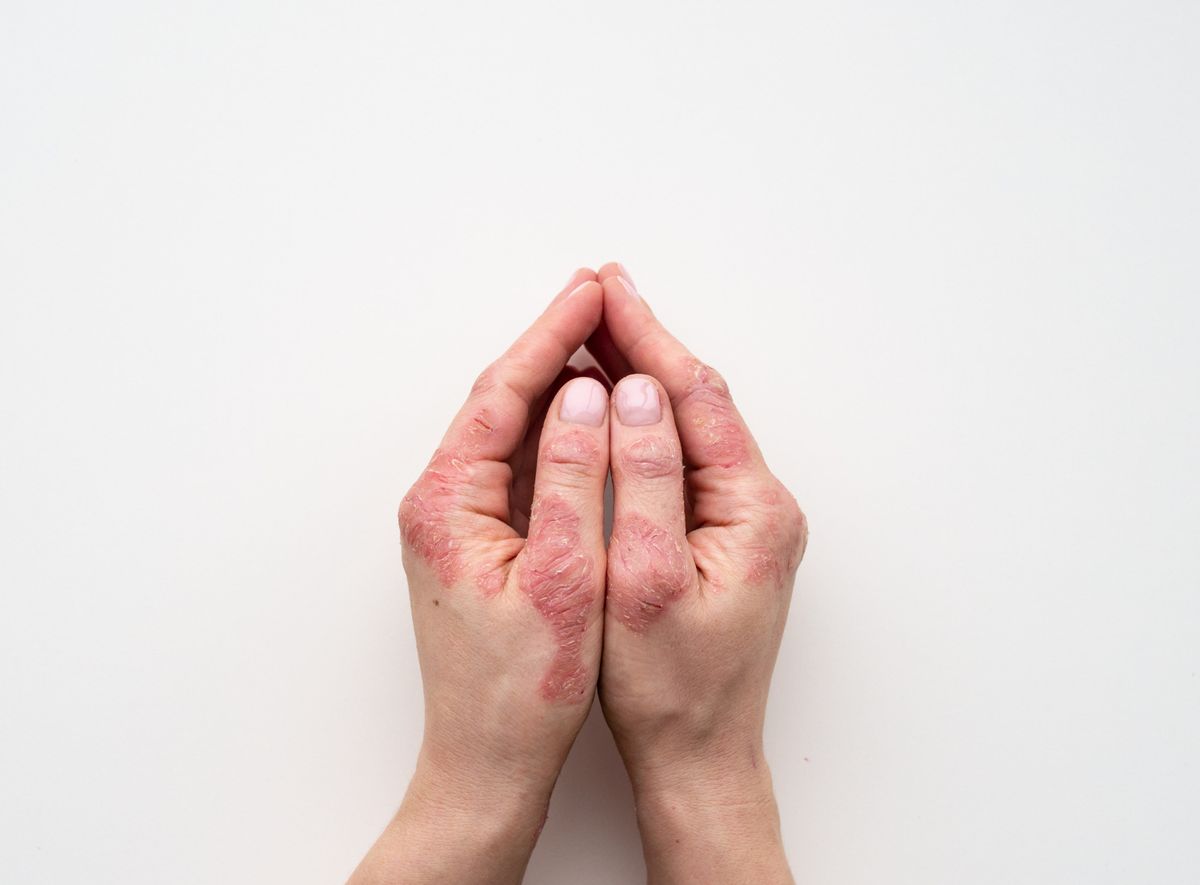 What Are the Latest Biologic Treatments for Severe Eczema
