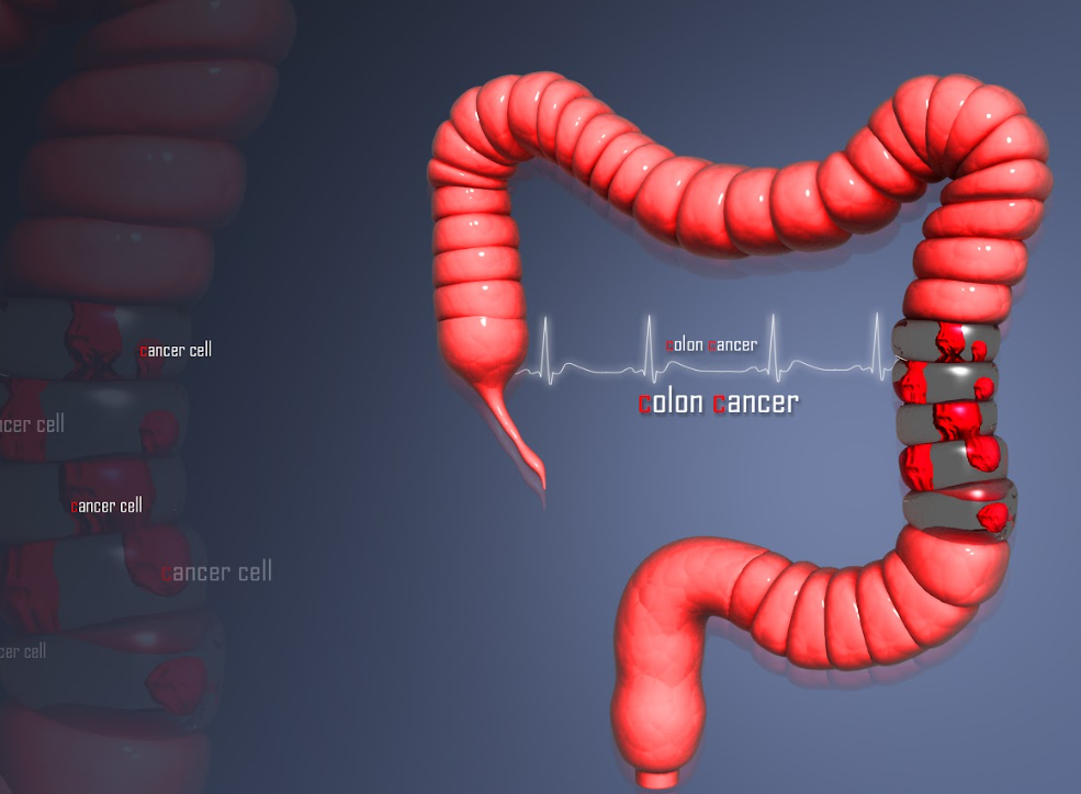 Comprehensive Treatment Options for Stage 4 Colon Cancer in Germany: Advanced Therapies and Expert Care