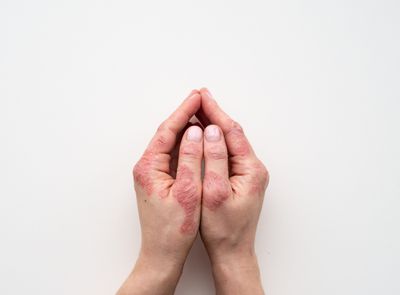 What Are the Latest Biologic Treatments for Severe Eczema