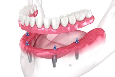 Dental Decisions: Are All-On-4 Dental Implants Worth It