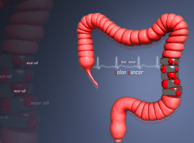 Comprehensive Treatment Options for Stage 4 Colon Cancer in Germany: Advanced Therapies and Expert Care