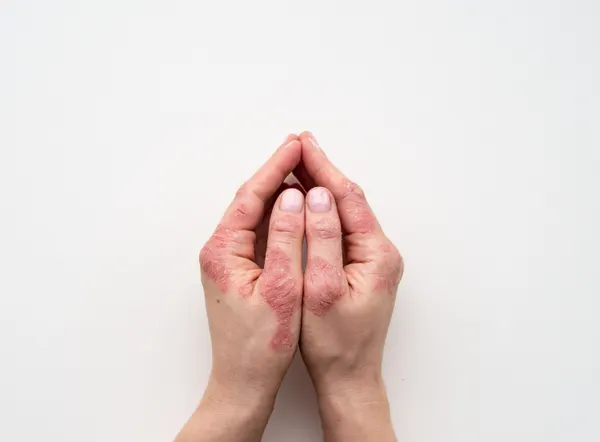 What Are the Latest Biologic Treatments for Severe Eczema