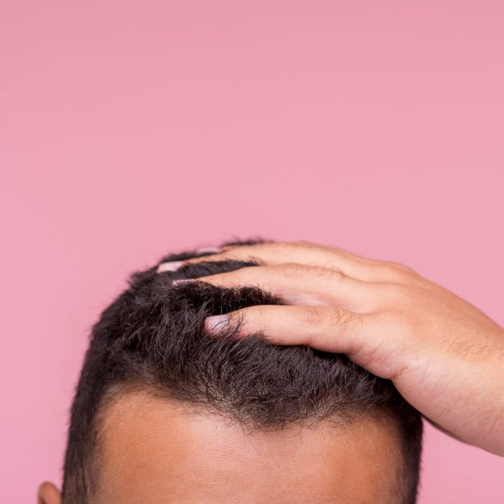 Did you know that almost 50 percent of women and around 80 percent of men struggle with hair loss - Post hair transplant care
