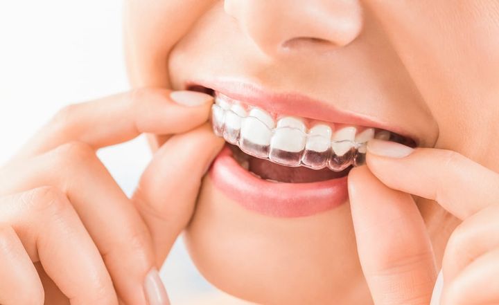 Exploring Clear Aligner Treatments for a Straighter Smile