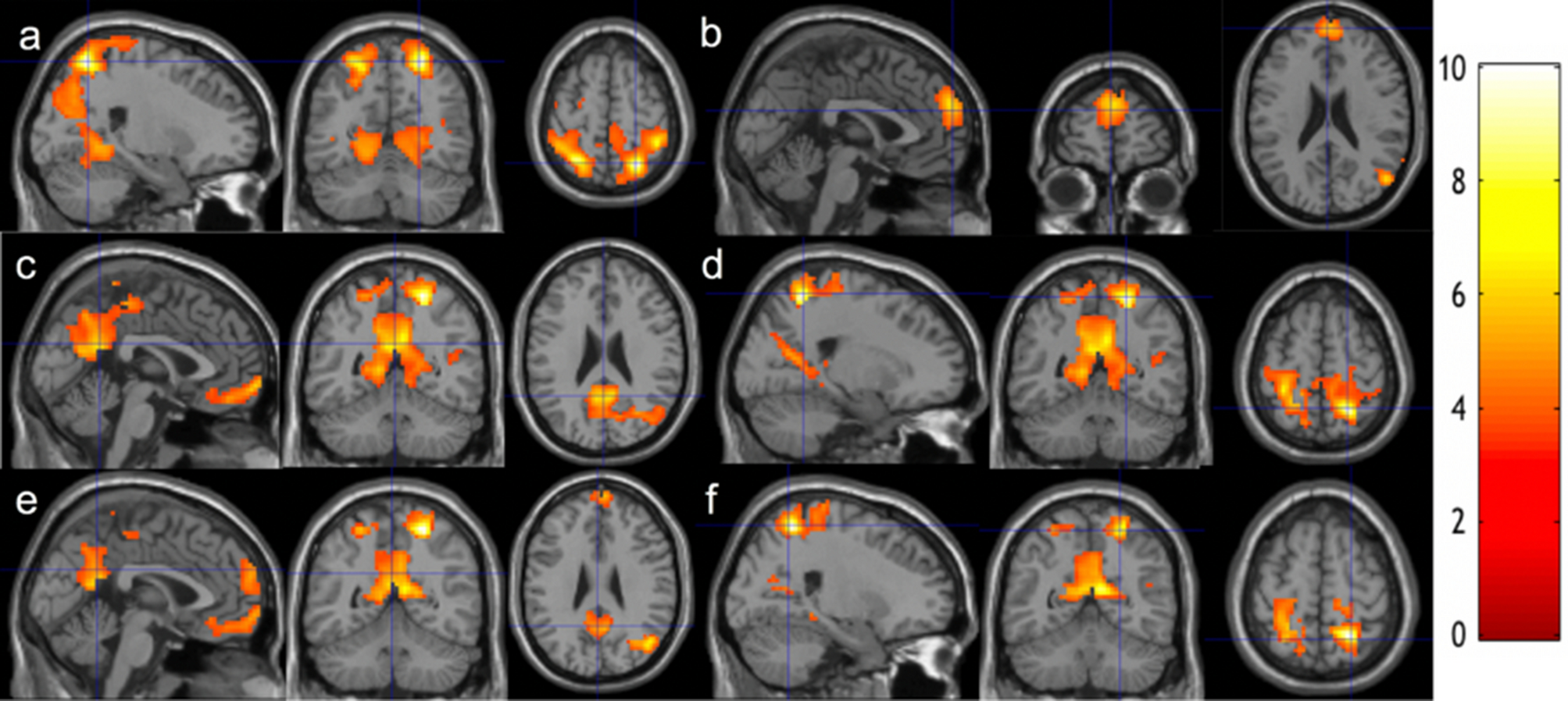 Functional MRI scans showing changes in brain activity through blood oxygen level dependent signals.
