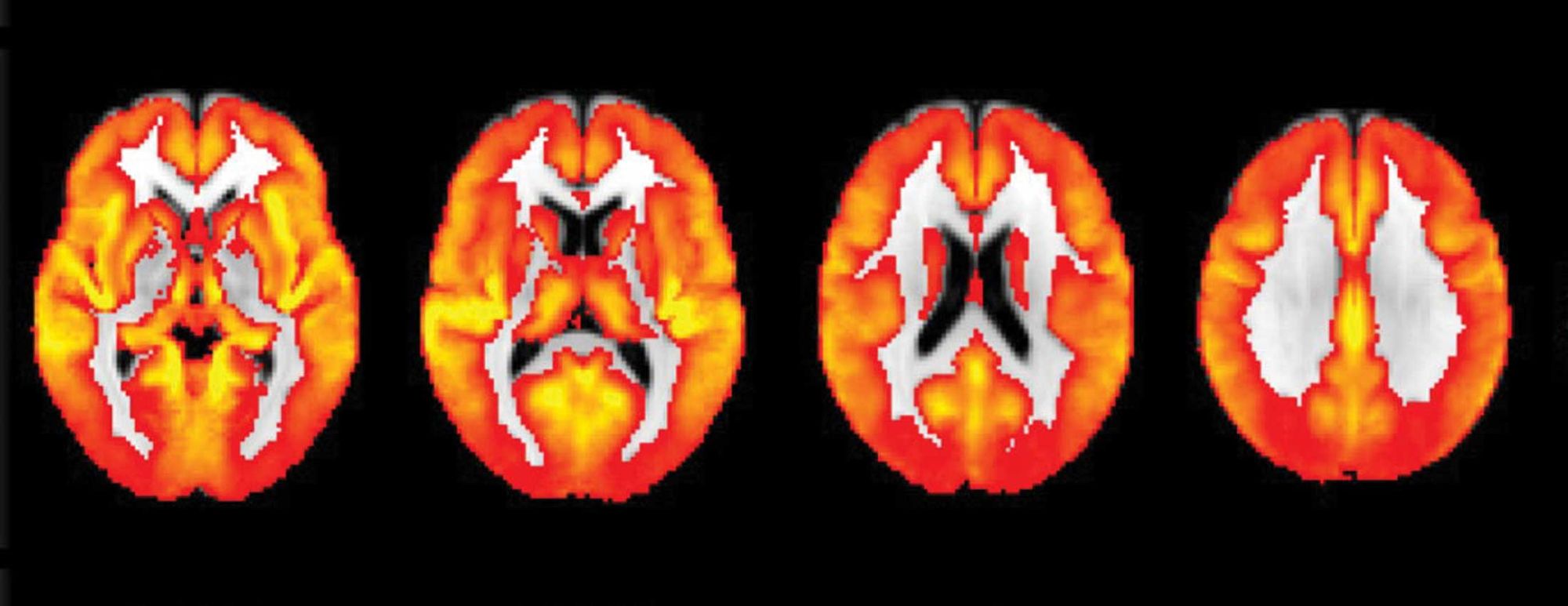 Tips to Remain Dementia-Free