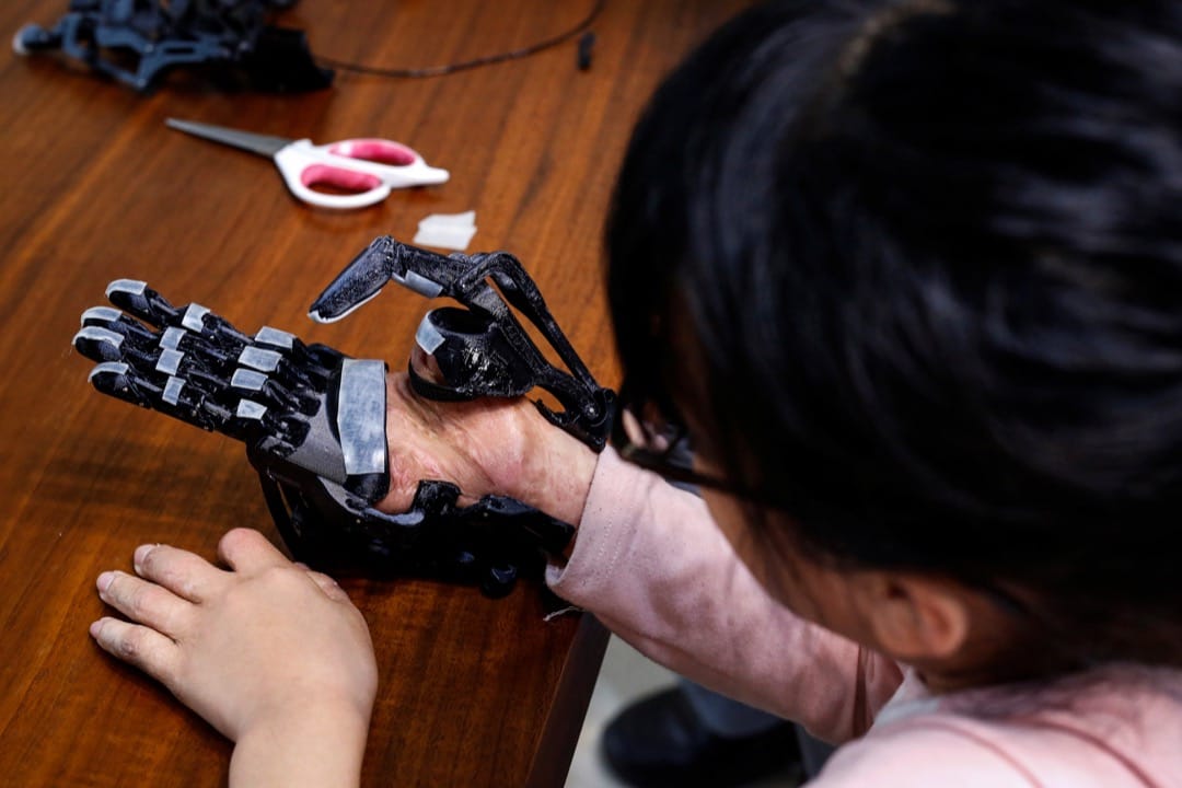 Angel的妈妈说她买不起昂贵的义肢。