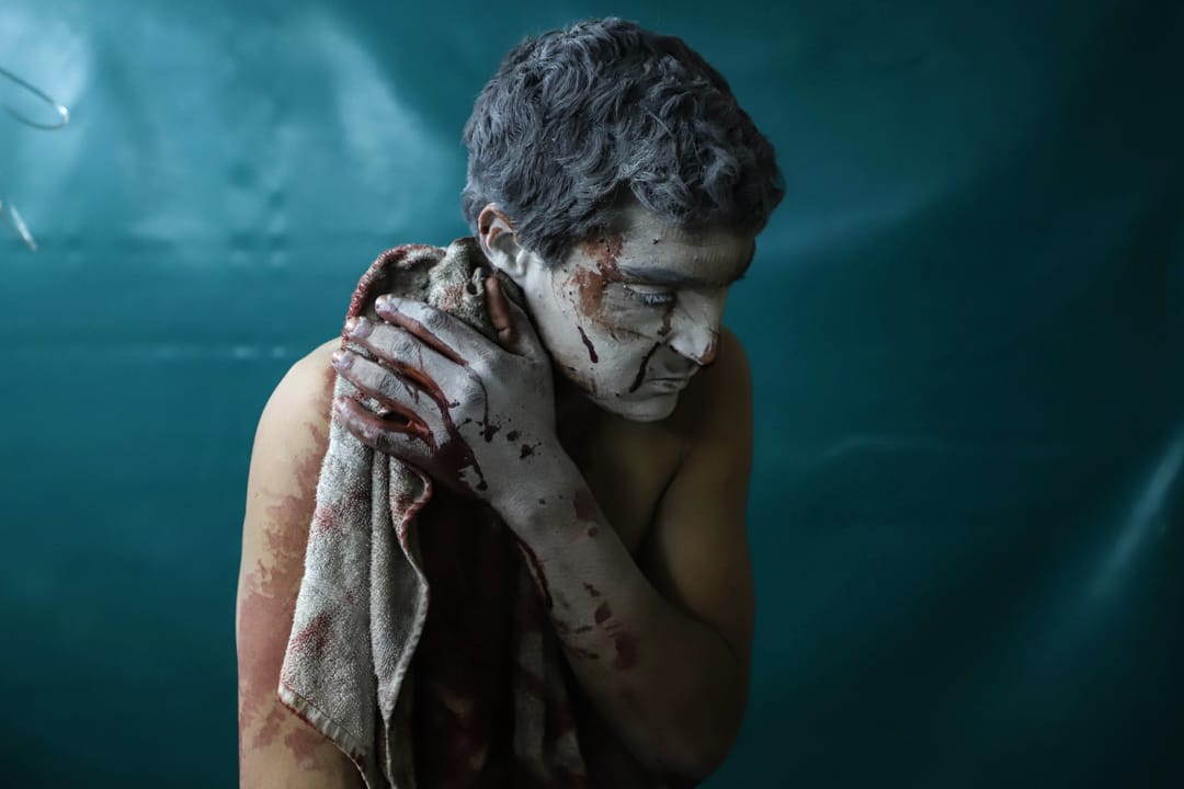 2018年3月13日，叙利亚大马士革，一名受了伤的叙利亚男子在市郊的一所临时诊所等候治疗。