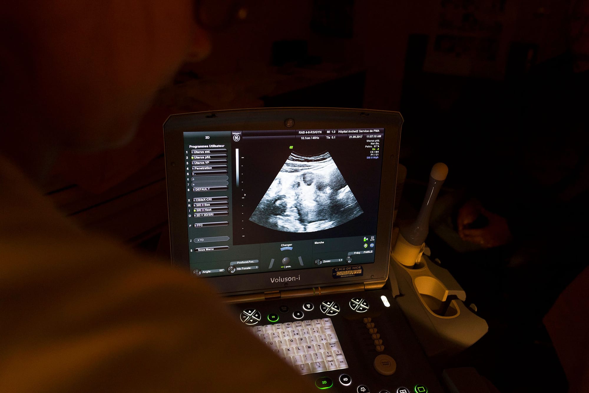 超音波控制下的胚胎移植。攝：BSIP/Universal Images Group via Getty Images