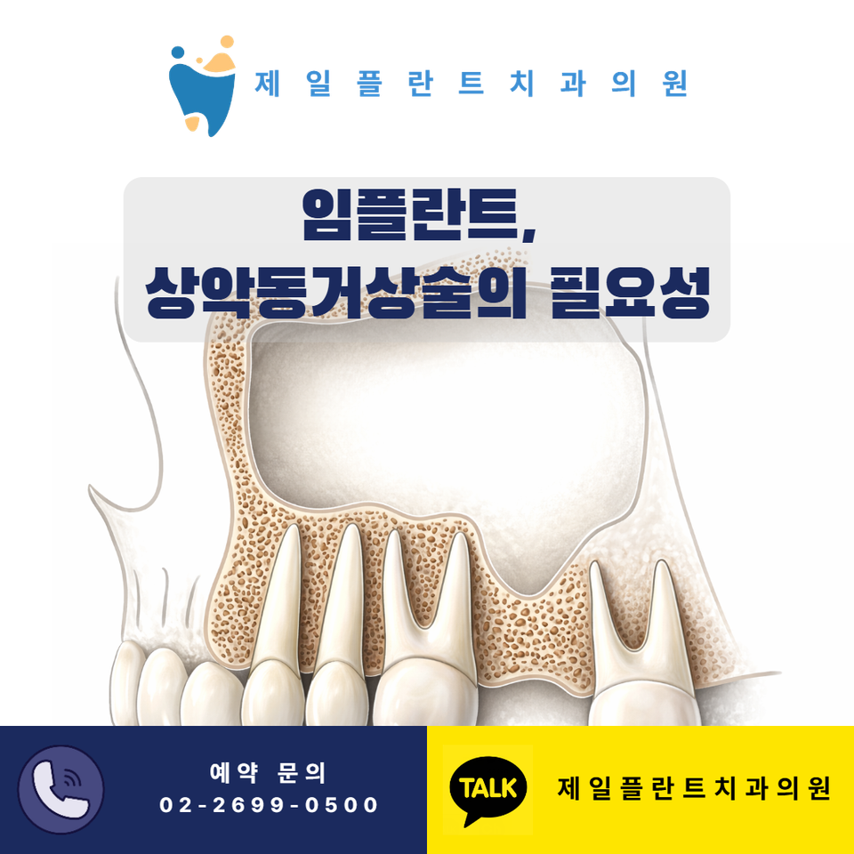 상악동거상술 임플란트 필요성