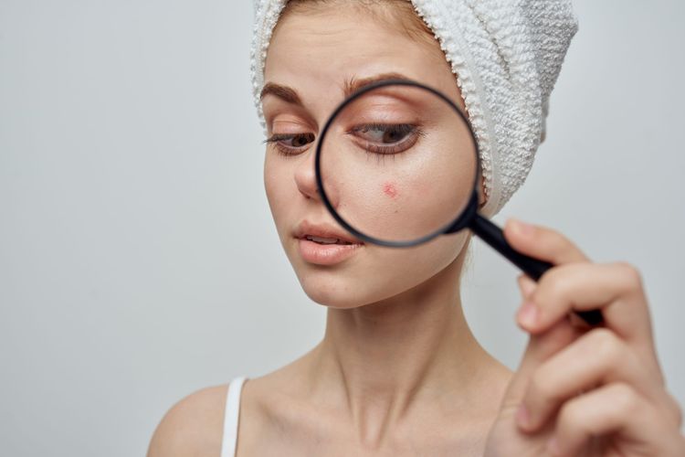 Post-Acne Marks: PIE vs. PIH. How to Identify and Fade Them!
