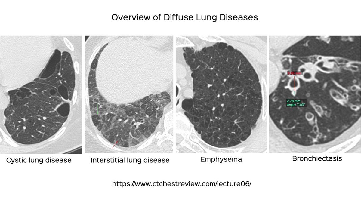 Diffuse Lung Diseases: Clinical Features， Pathology， HRCT [ペーパーバック] Maffessanti， Mario、 Dalpiaz， Giorgia、 Polverosi， R.、 Zompatori， M.、 Pesci， A.; Cancellieri， A. Diffuse Lung Diseases: Clinical Features， Pathology， HRCT