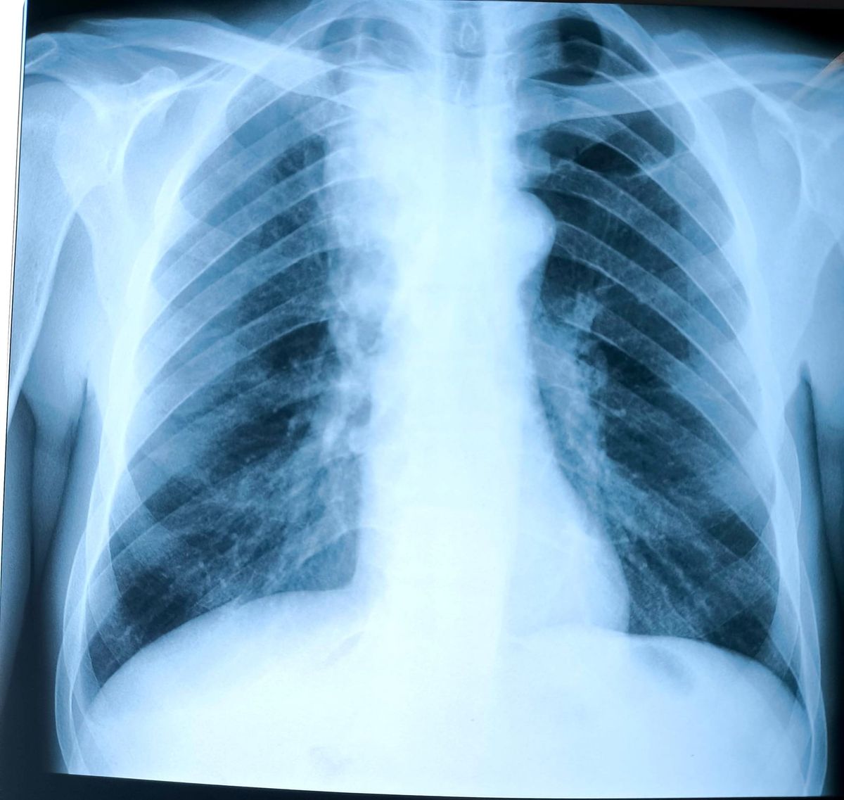 Airways & Mechanical Ventilation