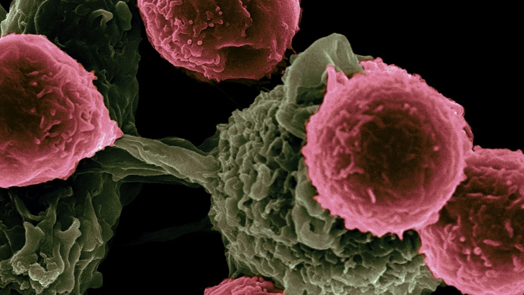 GigaTIME AI tool advances cancer research