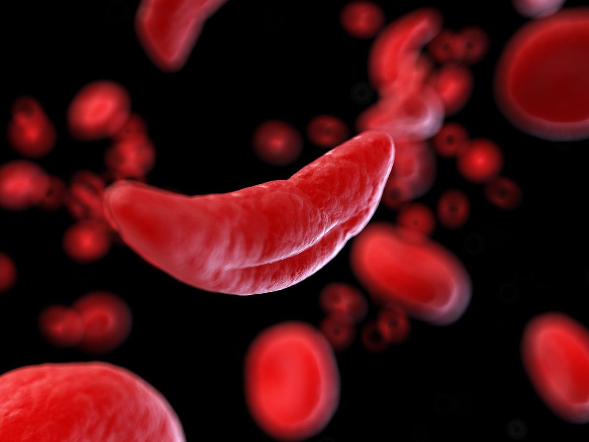 The First CRISPR Treatment: Changing the Fate of Sickle Cell Disease