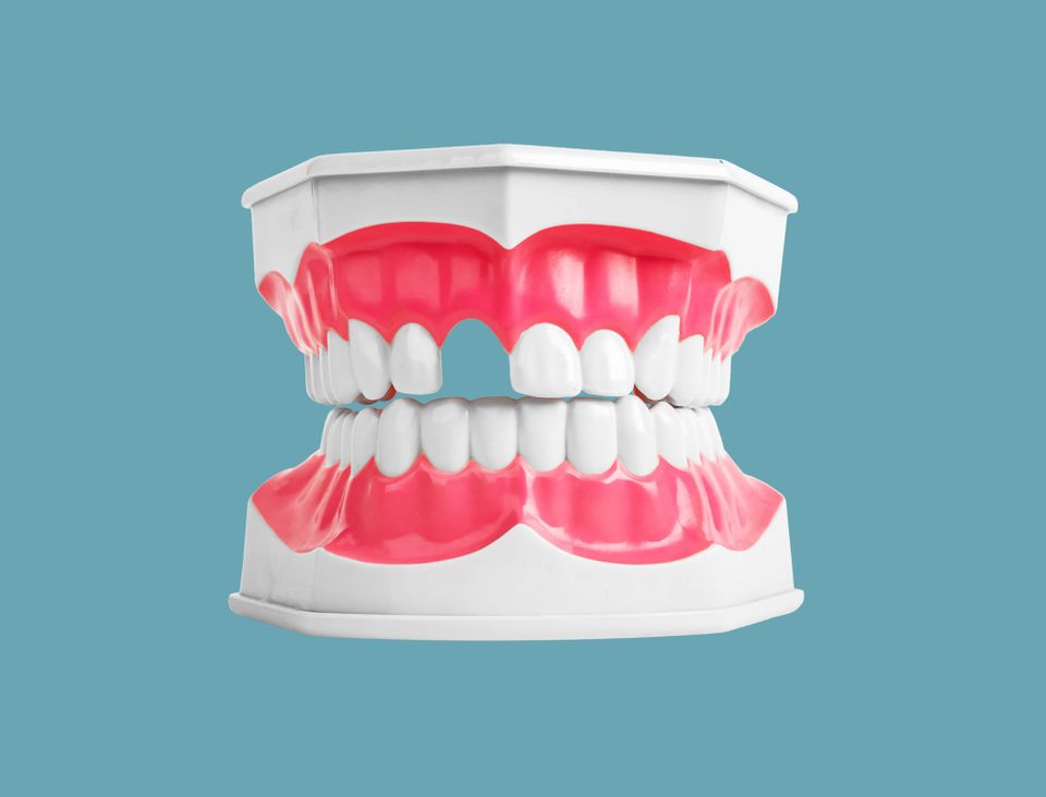 Why some patients want healthy teeth extracted