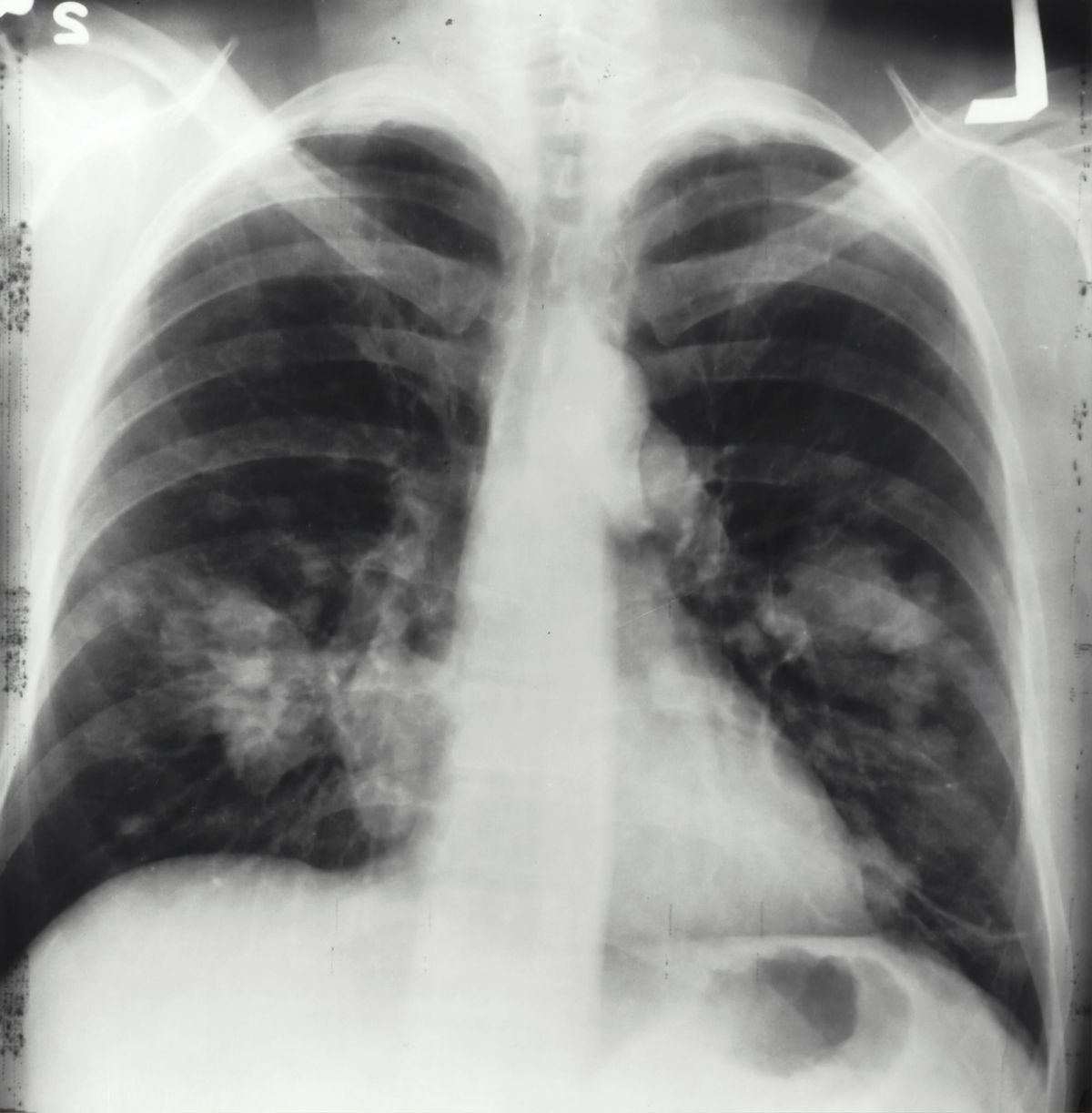 CO2: The Number That Tells Your Doctor How Well You're Breathing and Buffering