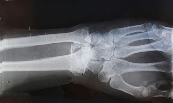 Calcium: The Mineral That Does Far More Than Build Bones