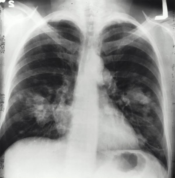 CO2: The Number That Tells Your Doctor How Well You're Breathing and Buffering