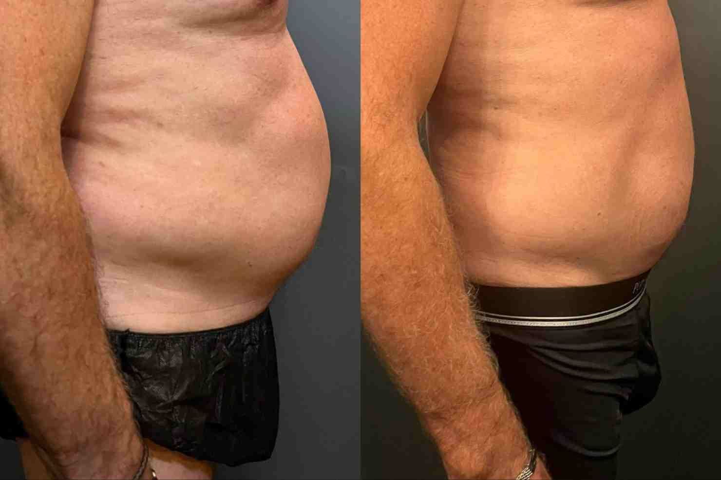 ¿Cómo eliminar grasa corporal sin cirugía? Tips y recomendaciones
