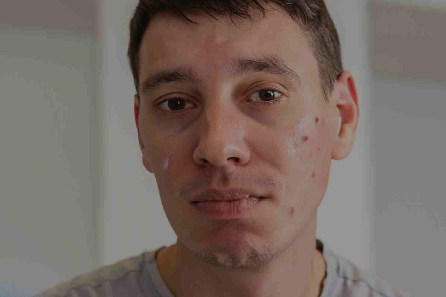 Tipos de acné en hombre y cómo prevenirlos. Tips y recomendaciones