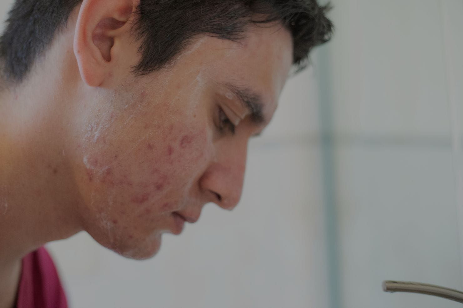 Tratamientos para el acné masculino: rutina diaria que sí mejora la piel