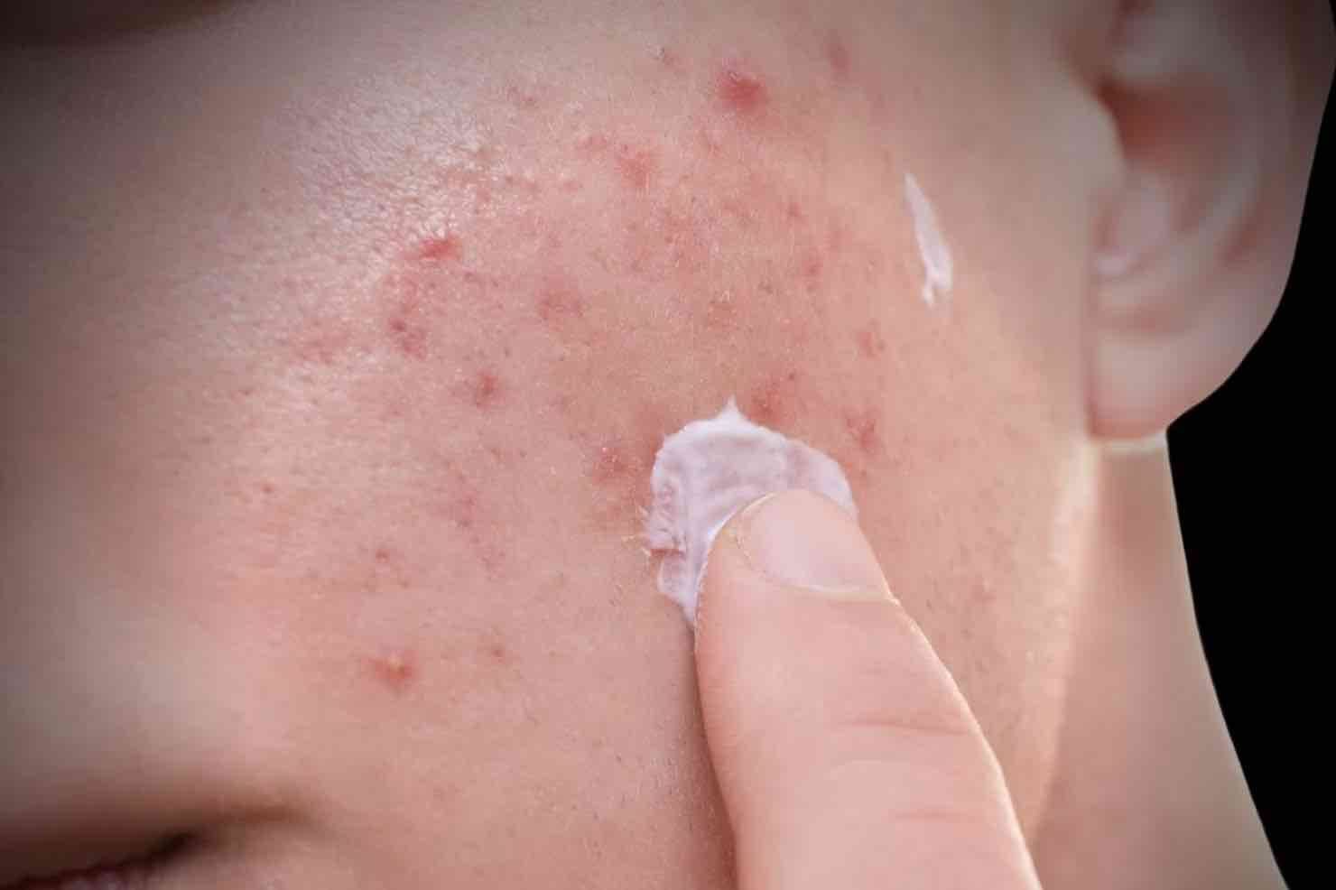 Acné hormonal en hombres: Causas y cómo tratarlo eficazmente