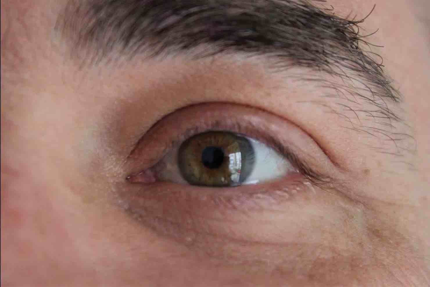 ¿Notas arrugas en los ojos? Soluciones efectivas para hombres
