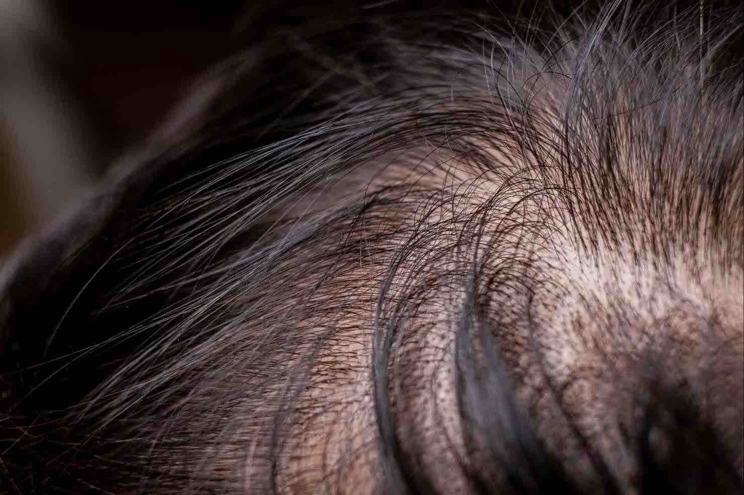 Lo que sí y lo que no funciona contra la caída del pelo