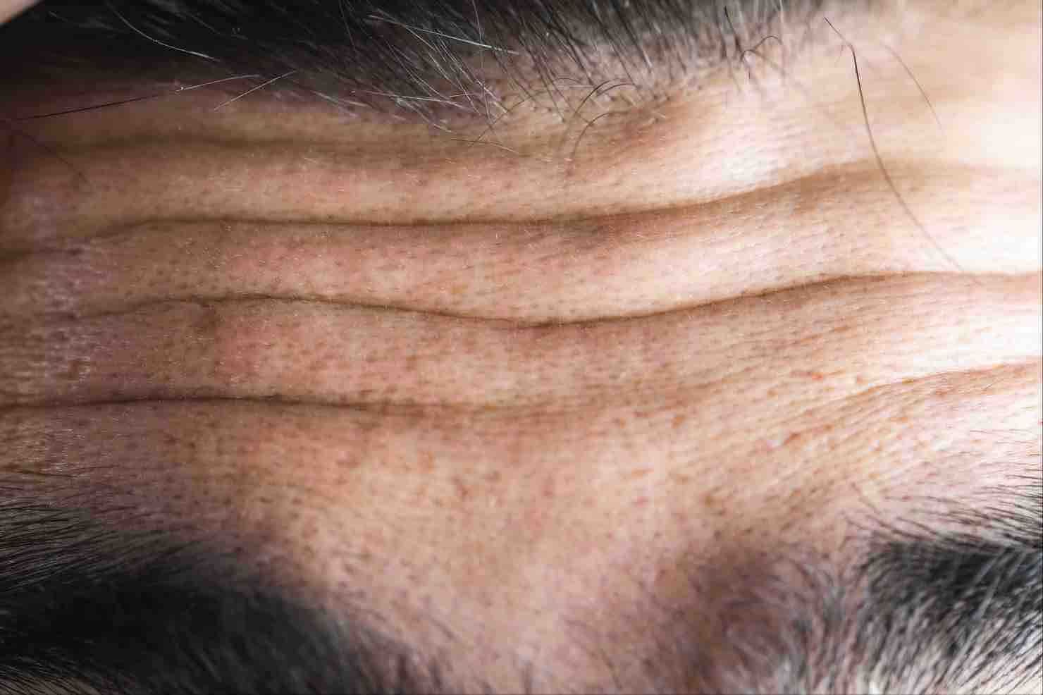 ¿Cómo los hombres pueden eliminar las arrugas de la cara?