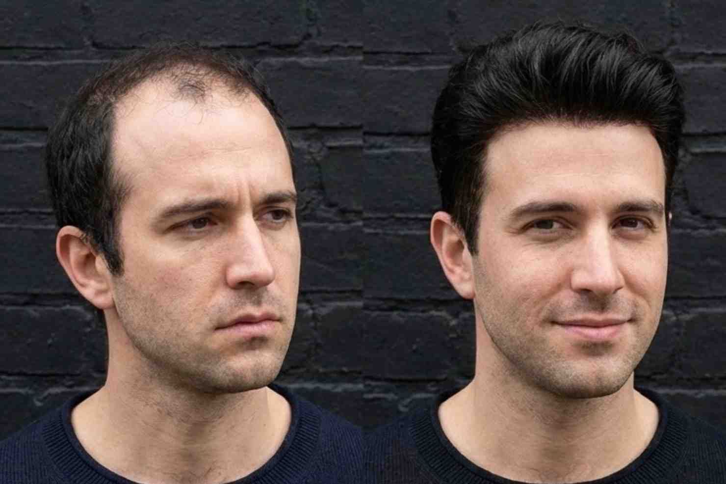 Qué es Elite Hair: sistema capilar con pelo natural