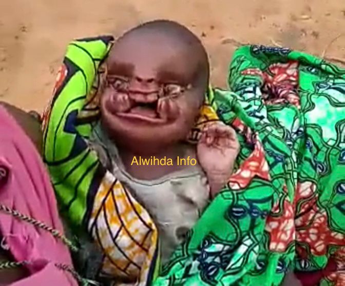 Tchad : naissance d’un enfant malformé à Lamé, un appel à l'aide lancé