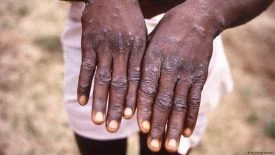 Variole du singe : Le Burkina Faso en alerte maximale