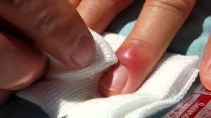 Tchad : Panaris, infection bactérienne ou pratique occulte ?