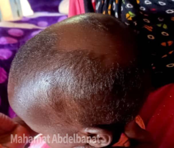 Tchad : une fillette de deux ans mordue par une hyène à Dagour dans le Salamat