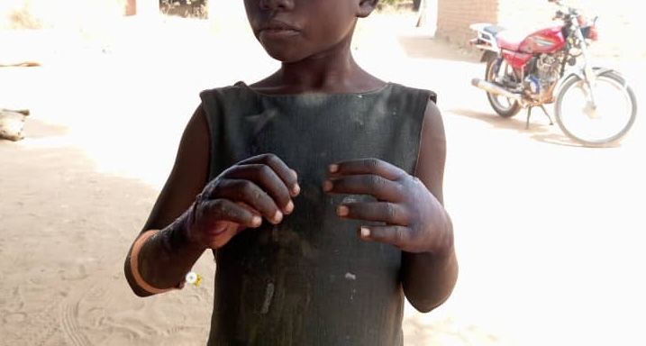 Tchad : une enfant brûlée par sa mère après une fausse accusation de vol