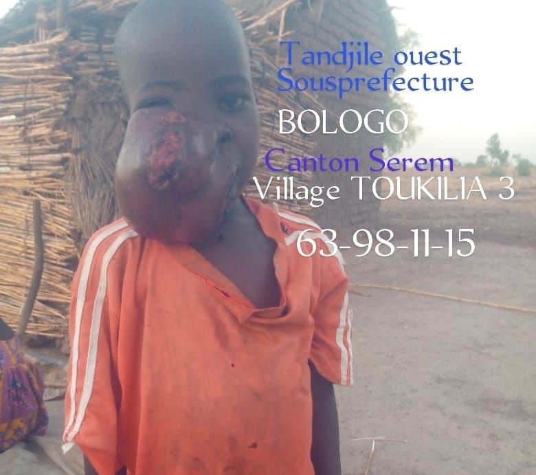 Tchad : appel à la solidarité pour un enfant souffrant d'une malformation dans la Tandjilé-Ouest