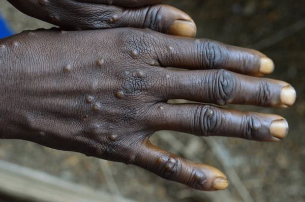 Lésions cutanées d’un cas humain de mpox – République démocratique du Congo – Mai 2023 Crédit photographique : Dr François Ka