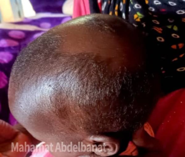 Tchad : une fillette de deux ans mordue par une hyène à Dagour dans le Salamat