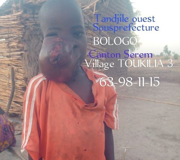 Tchad : appel à la solidarité pour un enfant souffrant d'une malformation dans la Tandjilé-Ouest