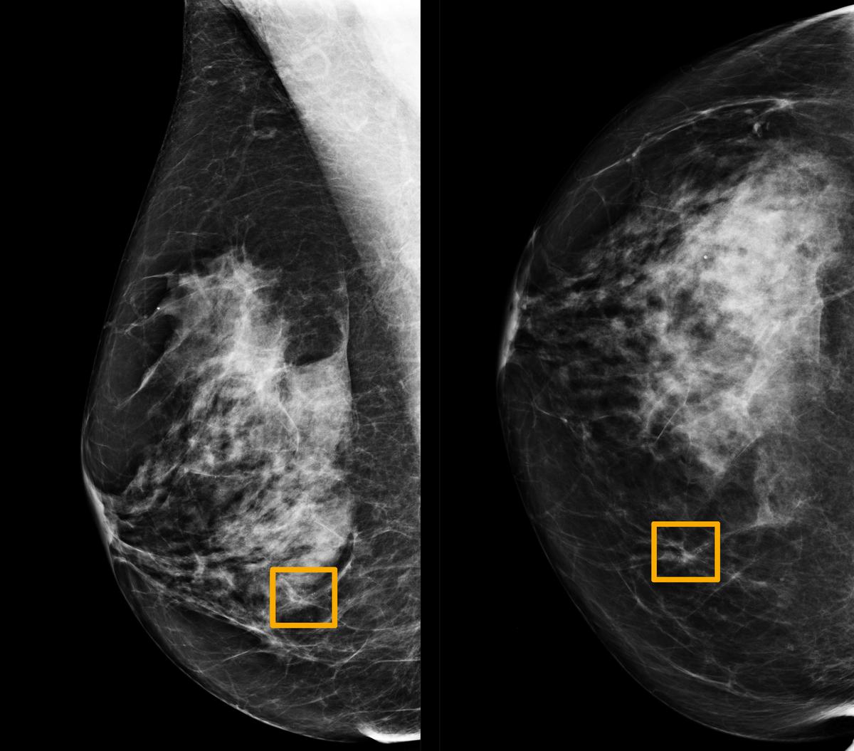 🎗 Artificiell Intelligens ökar träffsäkerheten vid diagnos av bröstcancer