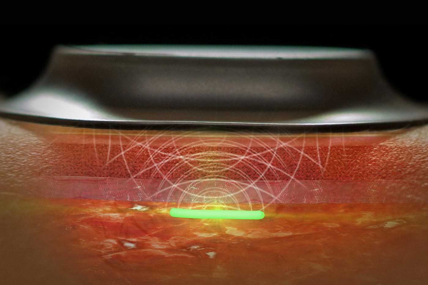 😷 En sensor under huden kan hjälpa oss upptäcka pandemier mycket tidigare