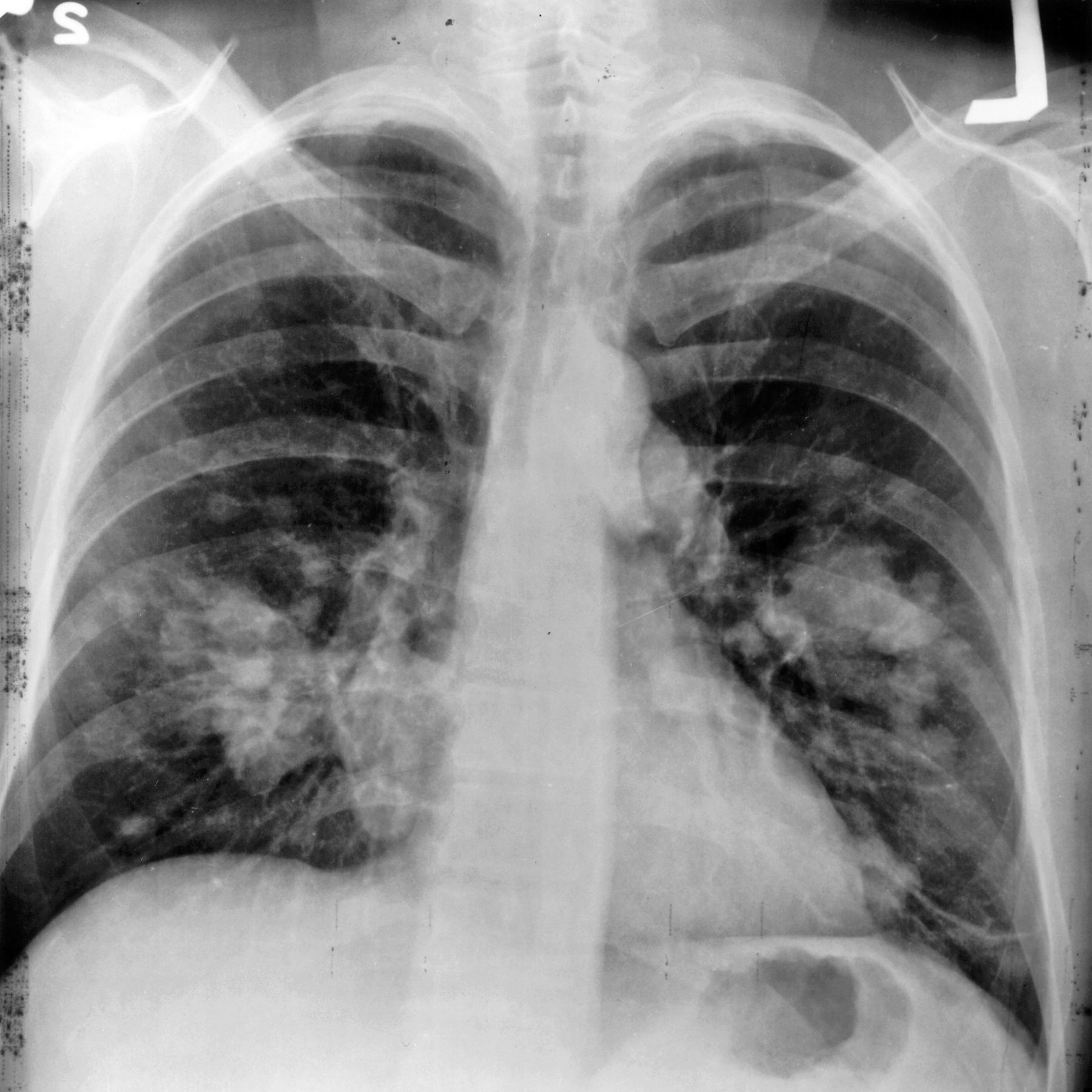 🎗  Skiktröntgen upptäcker lungcancer i tid