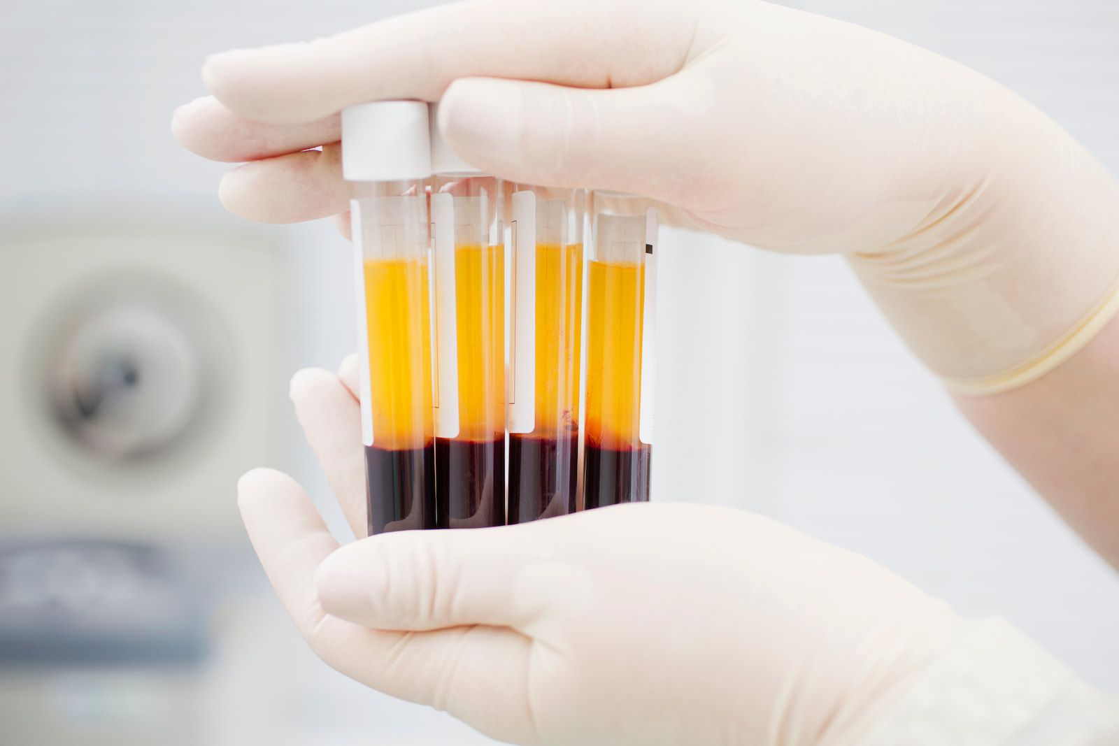 🩸 Lab-odlade röda blodkroppar: Ett revolutionerande steg i behandling av blodsjukdomar