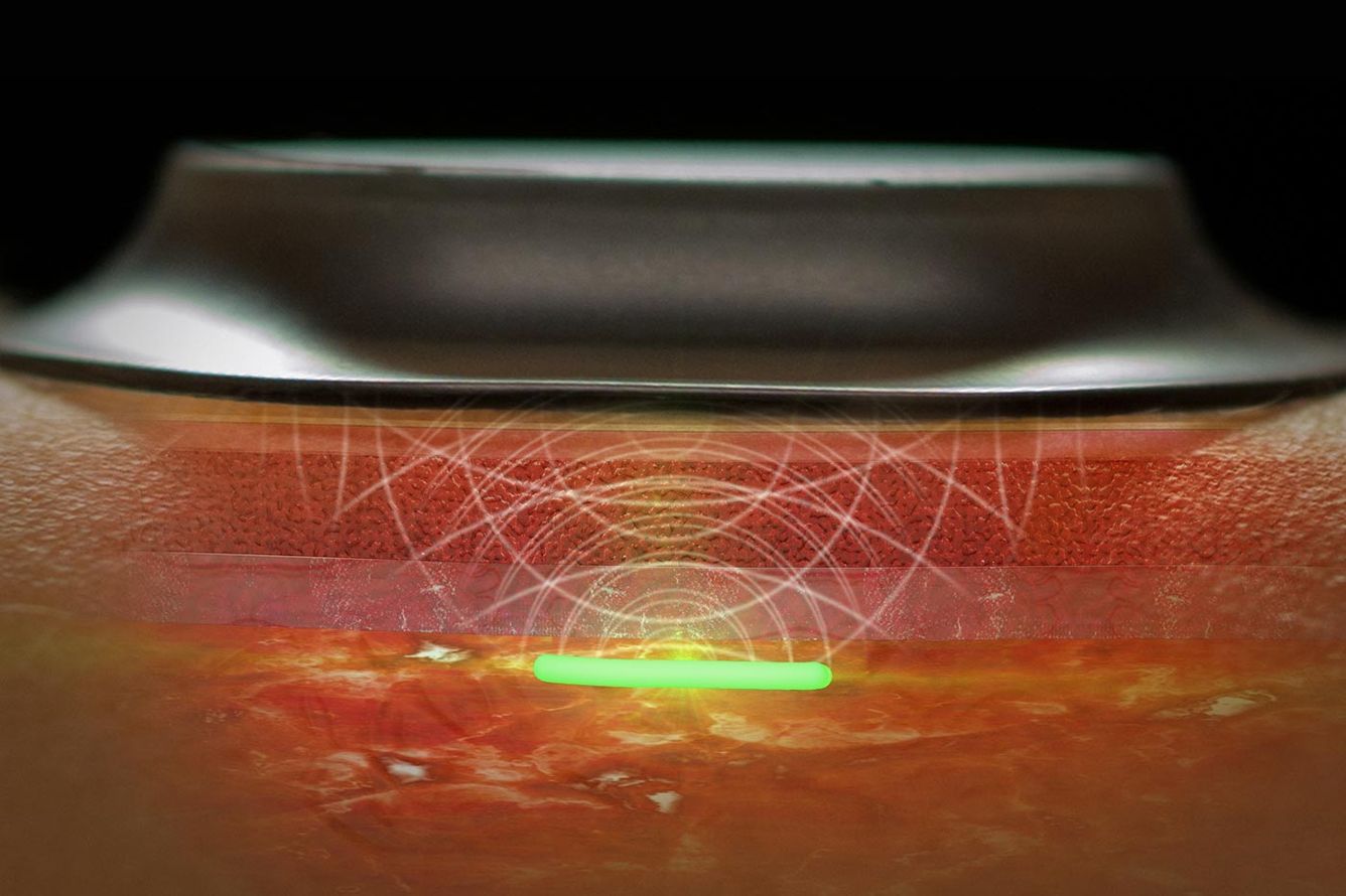 😷 En sensor under huden kan hjälpa oss upptäcka pandemier mycket tidigare